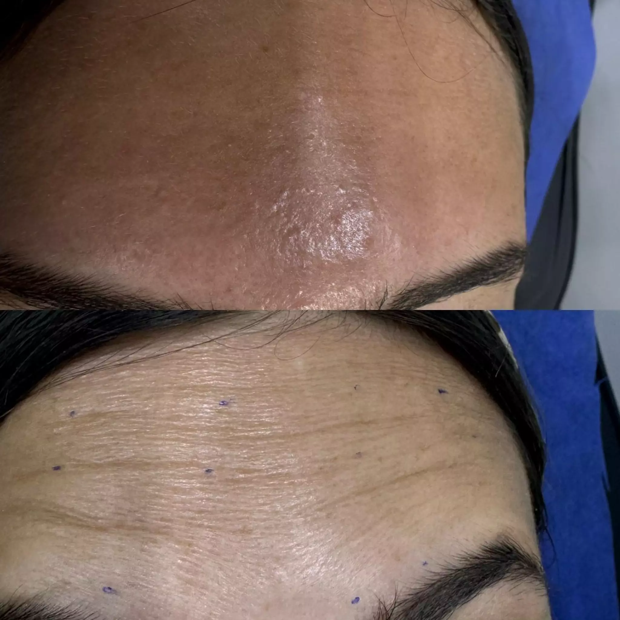 Botox in hurghada